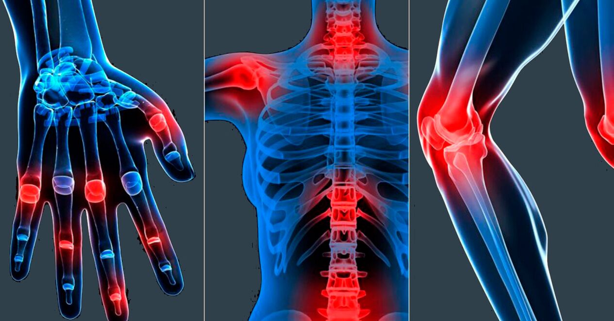 A Boswellia kivonat kapszulákban történő alkalmazására vonatkozó javallatok